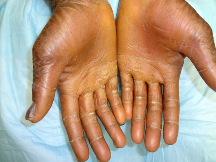 Ichthyosis Vulgaris - A Rare Genetic Skin Disease - Best ...